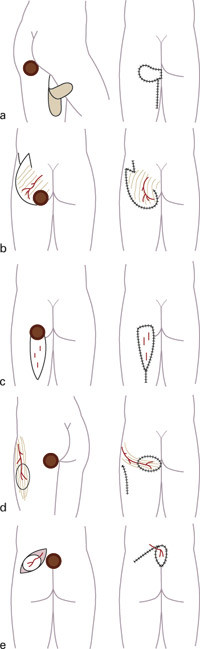 Figure 2  Various surgical procedures used to cover tissue defects after excision (and possible osteotomy) of pressure&hellip;