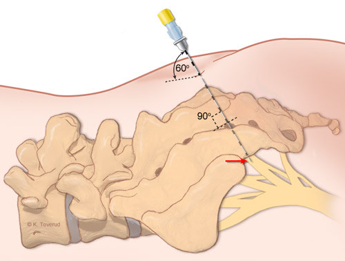 Figure 2:  Schematic drawing of cannulation of the third sacral foramen on the left side. The tip of the cannula (arrow)&hellip;