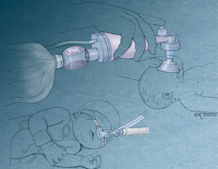 Oksygen kan tilf&oslash;res nyf&oslash;dte b&aring;de ved hjelp av bag og maske (&oslash;verst) og nese-CPAP (nederst). I dag anbefales det &aring; starte&hellip;