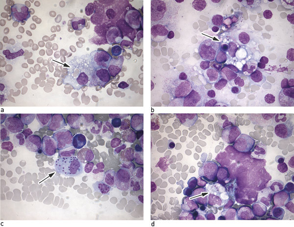 Figure 1  a) Bone marrow smear with macrophages with inclusions of erythrocytes (arrow). b) Bone marrow smear with&hellip;