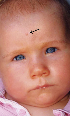 Figure 2  The bite that is assumed to be the port of entry for the infection. Published with the consent of the patient&rsquo;s&hellip;