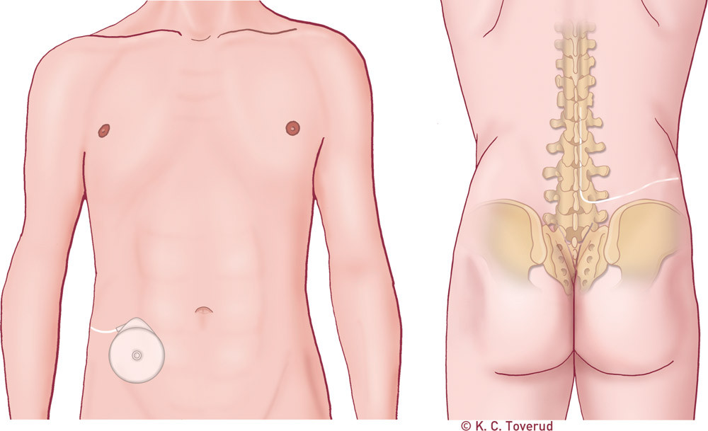 Figure 2  Implanted baclofen pump