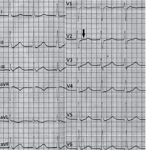 Figure 1:  ECG taken approximately one year prior to the admission in question. Supraventricular tachycardia with a&hellip;