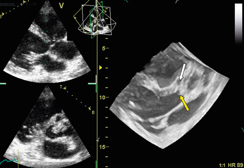 Fig 3  Transthoracic recording in patient with aortic valve endocarditis. The yellow arrowhead marks valvular vegetations&hellip;