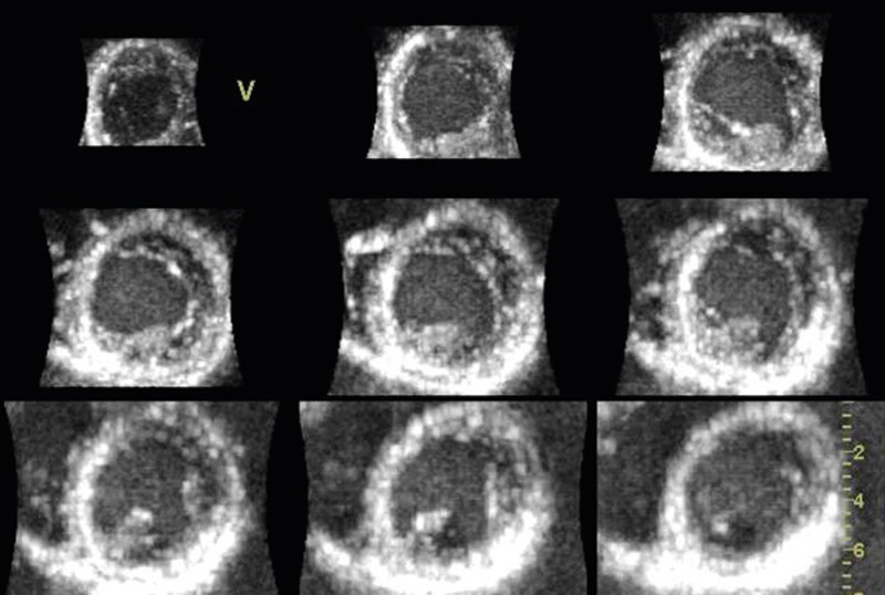 Figure 4  Short-axis sections of left ventricle from full volume recording in a normal, healthy individual. At the top left&hellip;