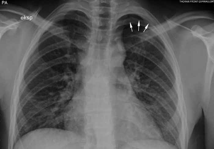 Figure 1  Chest X-ray taken during expiration shows a 12 mm apical air cap on the left side.
