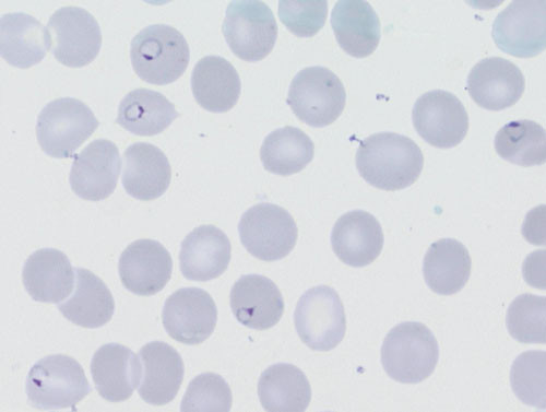 Figure 1 Plasmodium falciparum ring forms in peripheral blood smear from pregnant woman with severe malaria and 14&thinsp;%&hellip;
