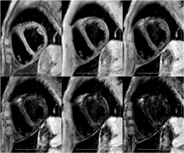 Figure 4  T2-weighted MR cor images show (from top left to bottom right) iron accumulation in the myocardium. Pathological&hellip;