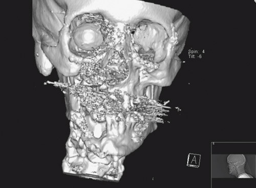 Figure 2  CT 3D midface reconstruction