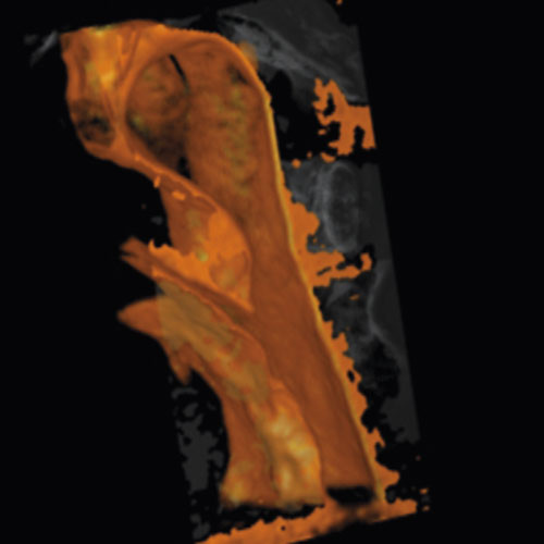 Figure 4  CBCT 3D reconstruction of larynx and throat