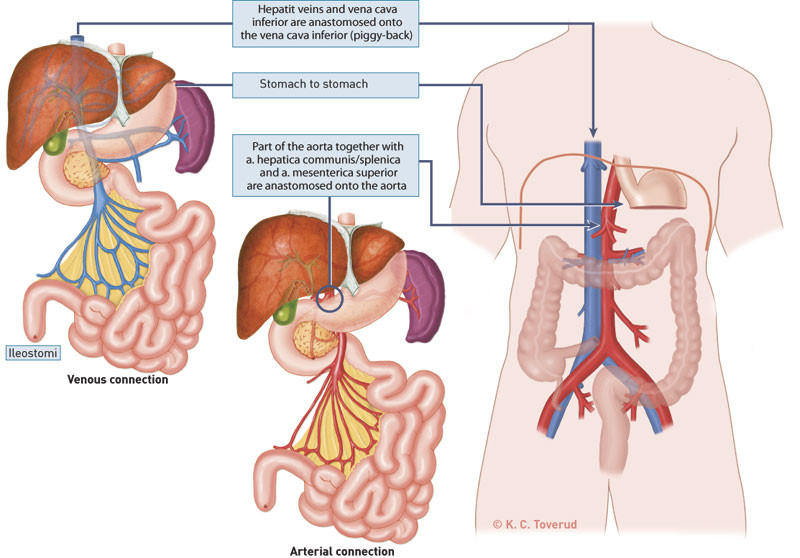 Figure 2   Multivisceral transplantation which encompasses small intestine, stomach, duodenum, pancreas and liver. It may&hellip;