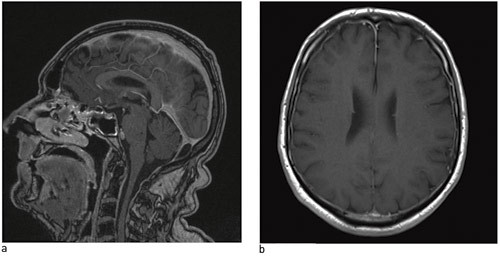 Figure 2  Cerebral MRI &ndash; a) from the side, b) from below &ndash; shows pachymeningeal enhancement with gadolinium in a man with&hellip;