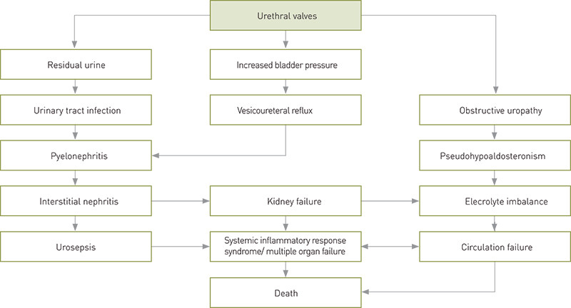 Figure 1  Possible consequences of urethral valves in infants. The figure is based on Paal H.H. Lindenskov&rsquo;s layout