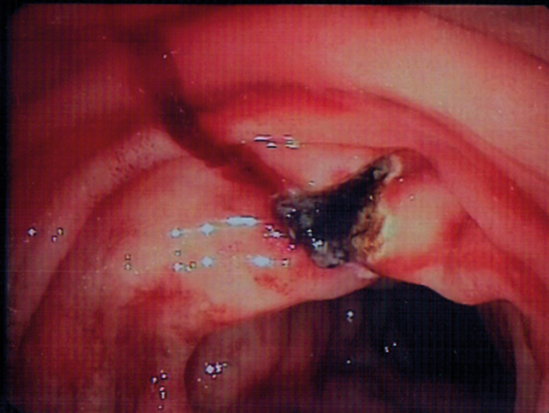 Figure 2  Haemostasis following injection of Aetoxysklerol and application of argon plasma coagulation