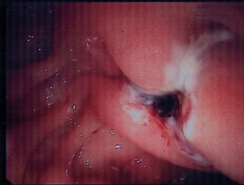 Figure 3  Surveillance gastroscopy the day after therapy shows that bleeding has stopped