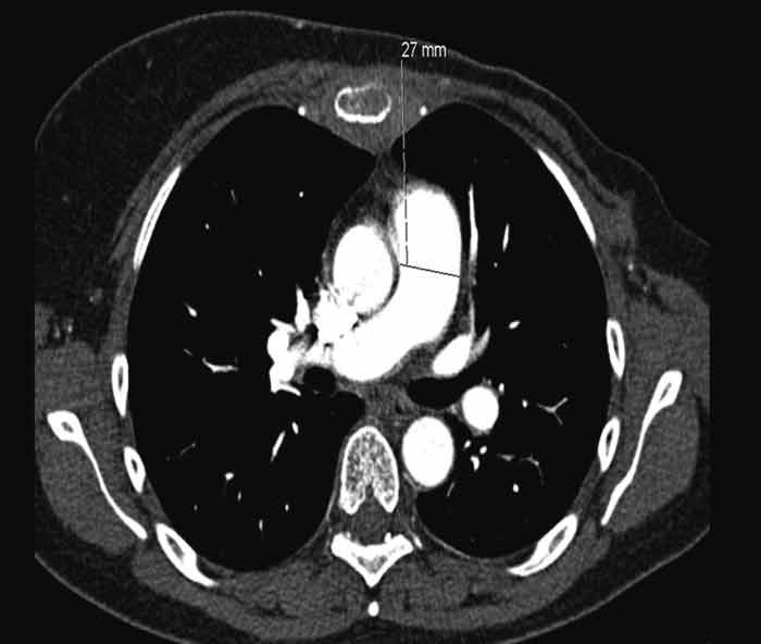 Figure 1  Volume CT thorax with intravenous contrast taken during the first admission to hospital. The truncus pulmonalis&hellip;