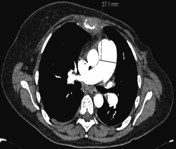 Figure 2  Volume CT thorax with intravenous contrast taken during last hospitalisations shows pronounced truncus pulmonalis&hellip;