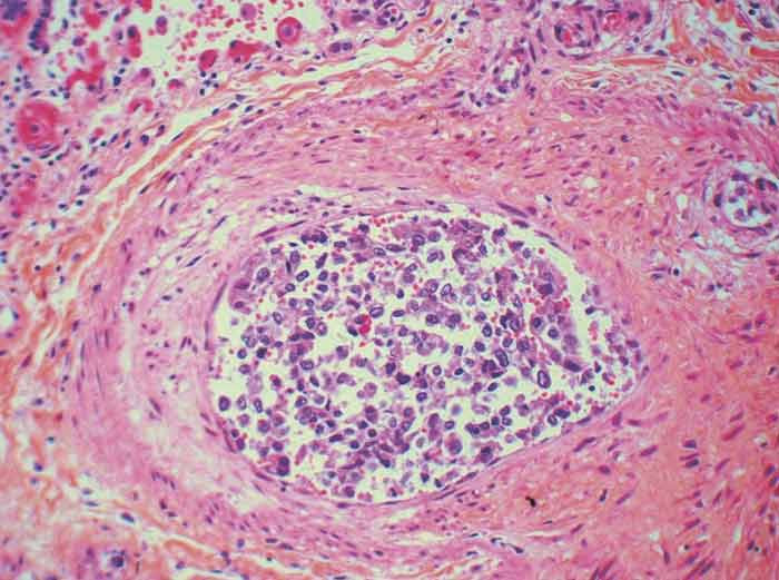 Figure 3  Small pulmonary artery with tumour cells in the lumen (haematoxylin erythrosine saffron (HES))