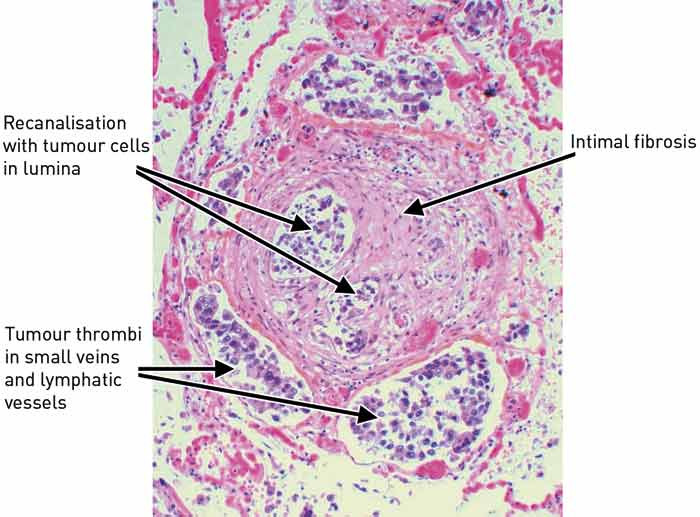 Figure 4  Artery with intimal fibrosis, recanalisation and tumour thrombi in both artery and associated veins/lymph vessels &hellip;