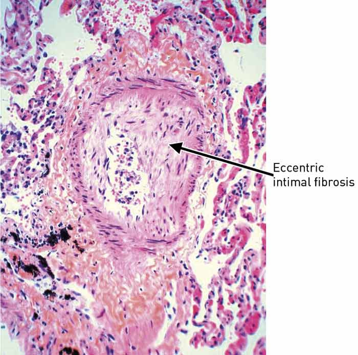 Figure 5  Small pulmonary artery with eccentric intimal fibrosis (HES)