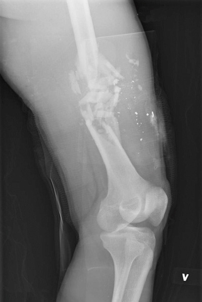 Figure 2:  X-ray of a thigh injury with a fracture and fragments from a high-velocity projectile from a rifle. The&hellip;