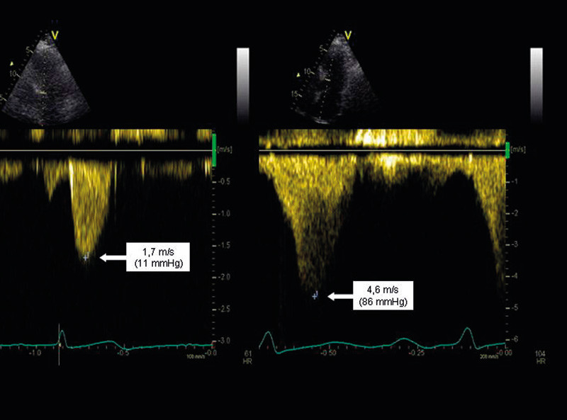Figure 2.  A patient with hypertrophic obstructive cardiomyopathy. Echocardiography with continuous Doppler registration of&hellip;