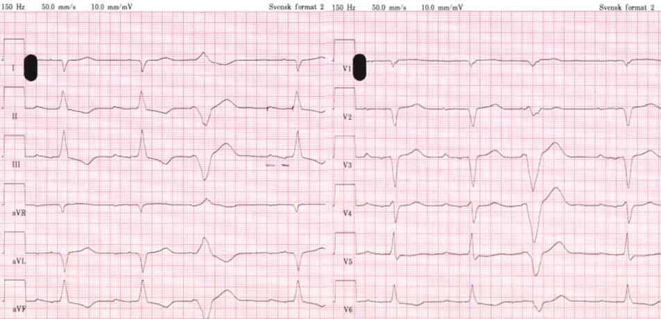 Figure 1  ECG (50 mm/s) recorded on admission showed sinus rhythm, 1st degree AV block with PQ-time 250 ms, suspected&hellip;