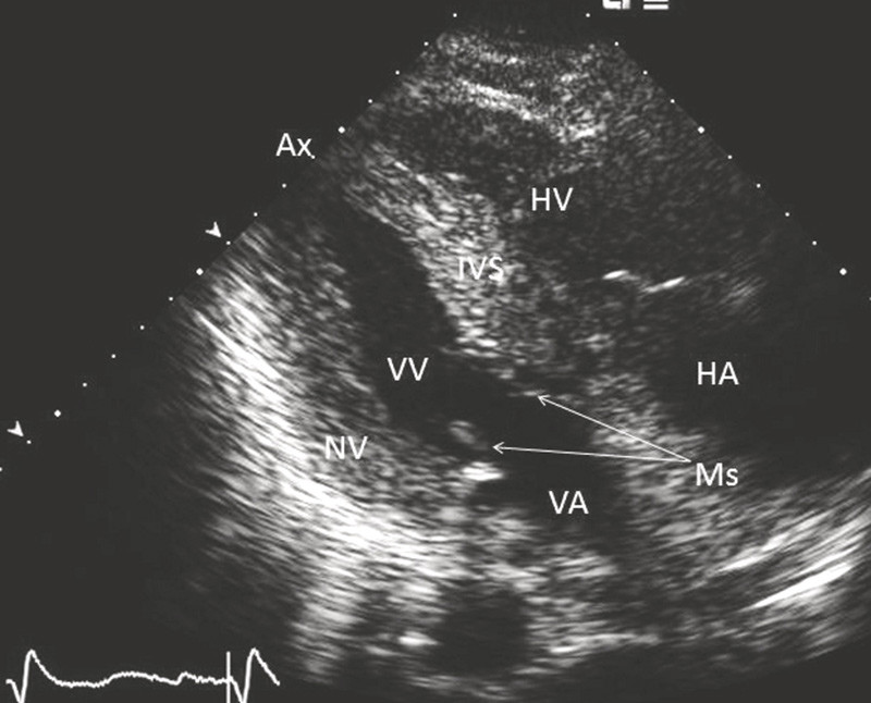 Figure 2  Echocardiography (slightly modified parasternal two-chamber view) shows left ventricle with hypertrophied walls&hellip;