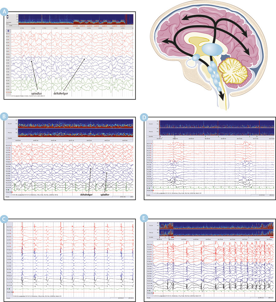 The top right shows an anatomical illustration of the ascending reticular activating system, which consists of two parts:&hellip;