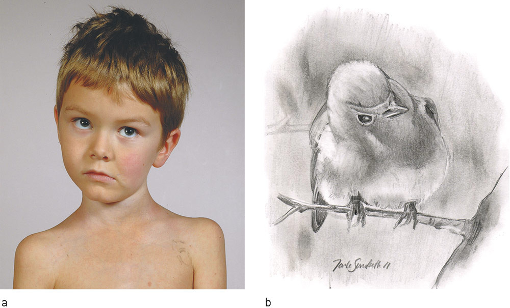 Figure 2  a) &laquo;Cock robin&raquo; position, thus named because it resembles the head position of a robin listening for a worm (b)&hellip;
