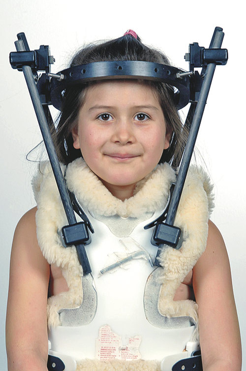 Figure 5  Postoperative external fixation in halo vest. The patient and her parents have given their consent for publication&hellip;
