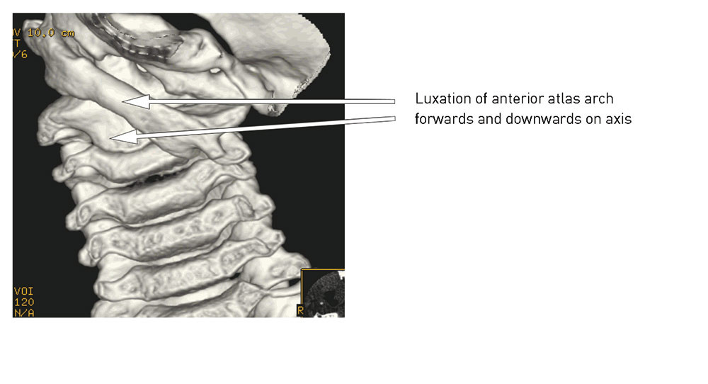 Figure 6  Total luxation left C1/C2 joint (anterior view)