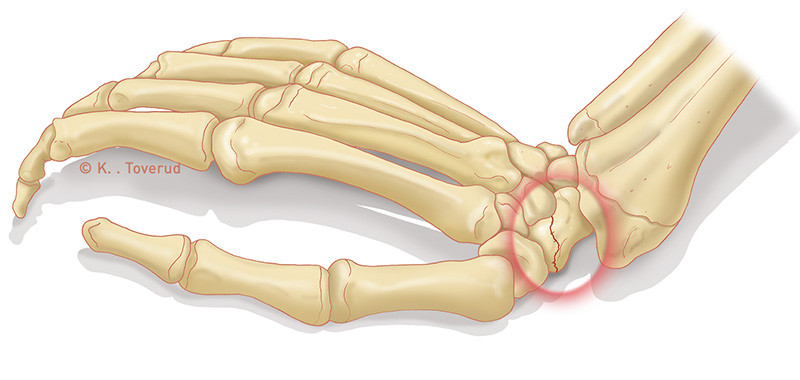 Figure 1  The most common injury mechanism in cases of scaphoid fractures
