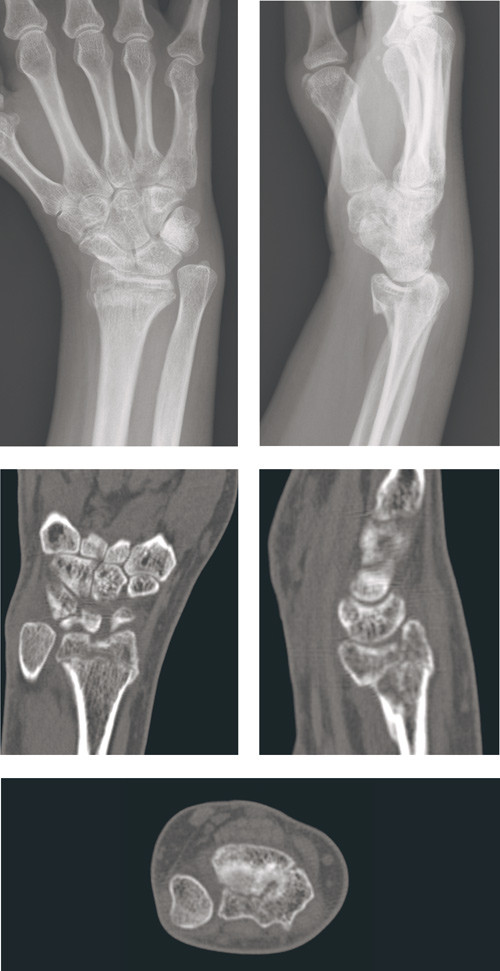 Figure 1  Radiological result after conservative treatment of unstable, intra-articular distal radius fracture in patient in&hellip;