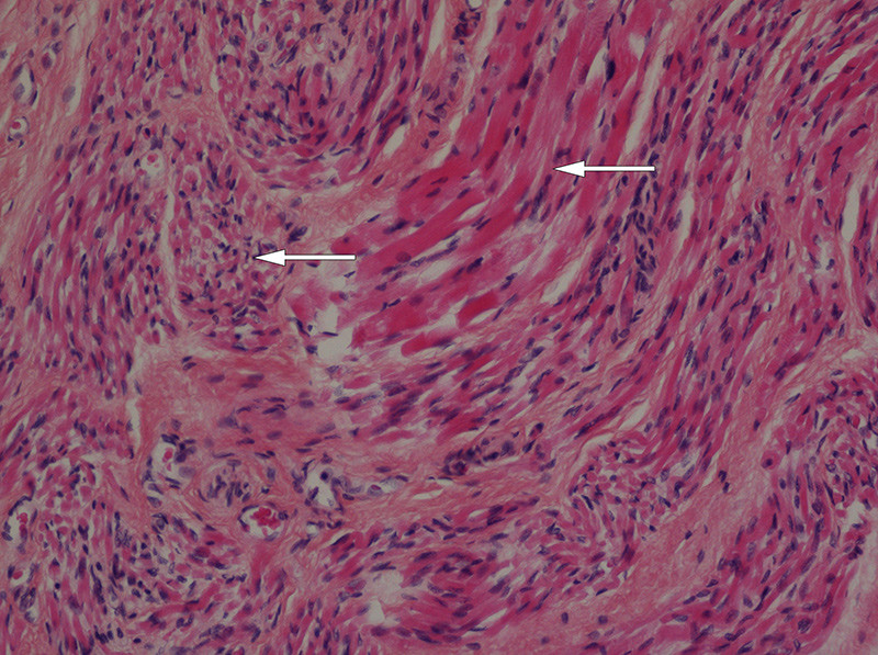 Figure 4  Biopsy from arm muscle showing grouped muscular atrophy with atrophic fibres (arrowhead) surrounding a bundle of&hellip;