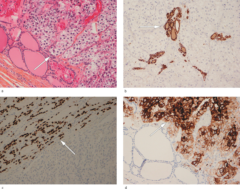 Figure 1  Metastasis from renal cell carcinoma bordered by normal thyroid follicles. a) Hematoxylin-eosin-safran stained&hellip;