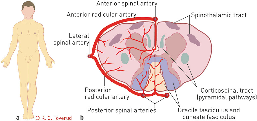 Figure 1  a) The extension of the patient's neurological impairment shown in yellow and b) a section of the spine with blood&hellip;