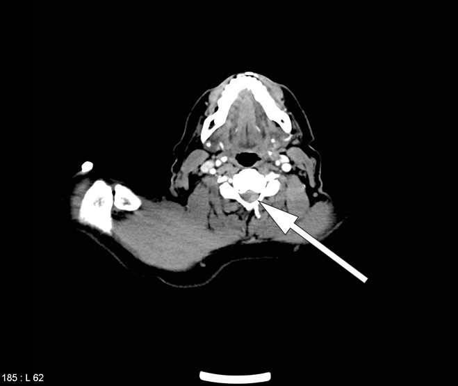 Figure 3  CT image which with retrospective interpretation was found to show the epidural haematoma at the time of admission
