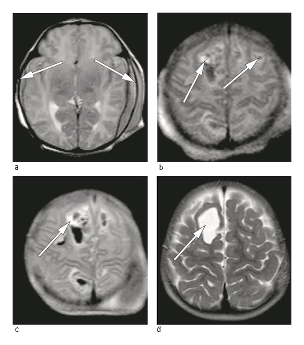Figure 1  MRI of head, T2 image with 1.5 Tesla scanner. The images during the first day of life show a) fresh subdural&hellip;