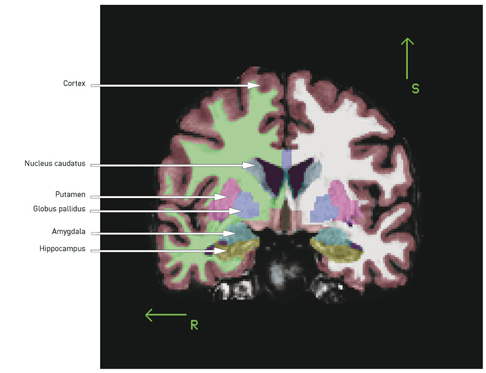 Fig. 1  Coronal section of T1-weighted MR image, automatic volume estimation using MRI post-processing tool FreeSurfer. R =&hellip;