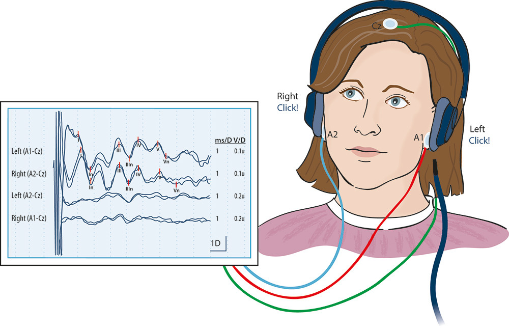Figure 2  Brainstem auditory evoked potentials (BAEP). This is a study of the auditory system where the auditory paths are&hellip;