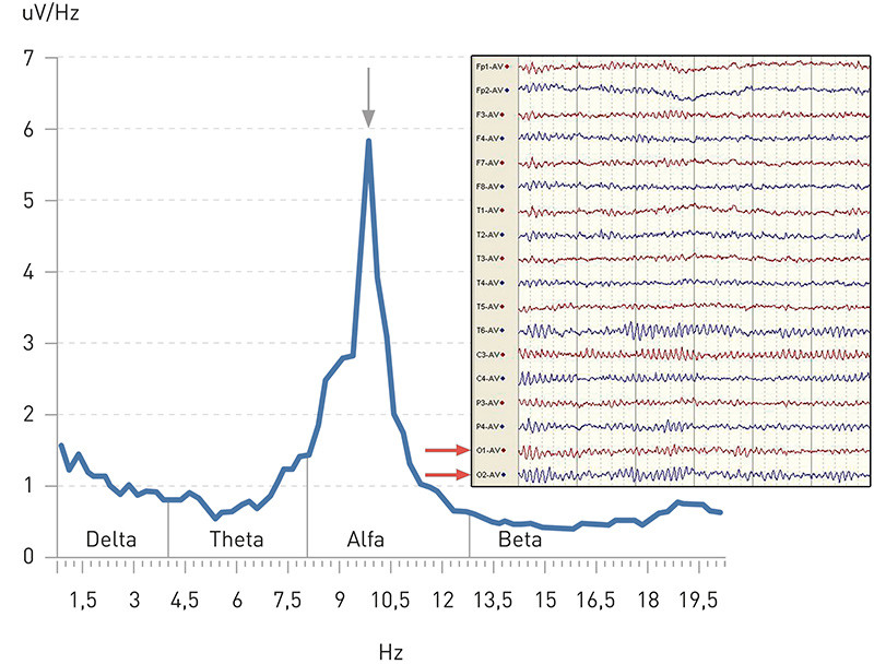 Fig. 1  Normal EEG of a waking adult, eyes closed, is shown accompanied by the associated frequency-distribution curve. The&hellip;