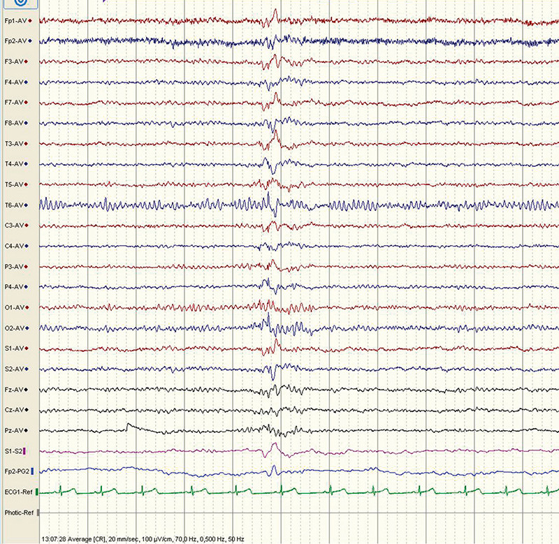 Fig. 2  EEG of a subject with acute depressive periods. Normal background activity. One single brief, generalised&hellip;