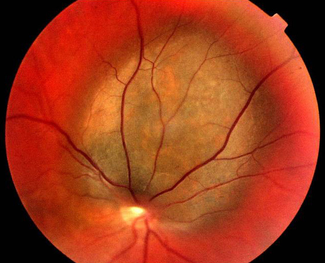 Figure 4  Malignant melanoma starting in the eye. Photo Nils A. Eide