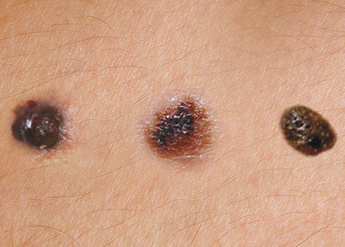 Figure 1  Photo montage of malignant melanoma, atypical pigmented naevus and seborrheic keratosis on the skin