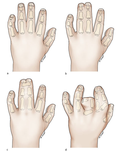 Figure 2  Classification of syndactyly. Syndactyly between long and ring finger. a) Simple incomplete syndactyly b) Simple&hellip;