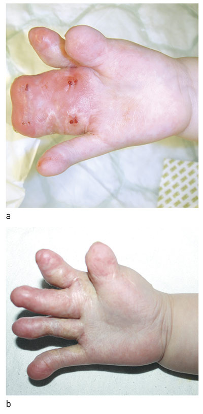 Figure 4  Tissue expansion using external distraction device (&laquo;magic cube&raquo;) in a patient with complex syndactyly. Photograph&hellip;