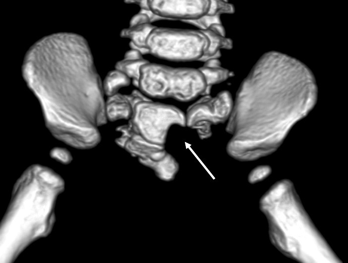 Figure 1  Three-dimensional reconstruction of a volume CT scan showing a marked scimitar defect in the sacral bone,&hellip;