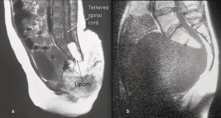 Figure 3  a) Midsagittal MRI showing a tethered spinal cord and intraspinal lipoma. b) Midsagittal MRI showing an anterior&hellip;