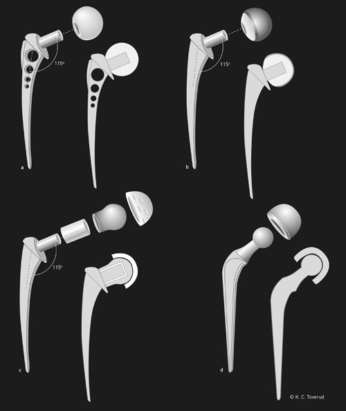 Figure 3  a) Christiansen&rsquo;s hemiprosthesis as used in the period 1965&thinsp;&ndash;&thinsp;67. A loose femoral head articulates with a&hellip;